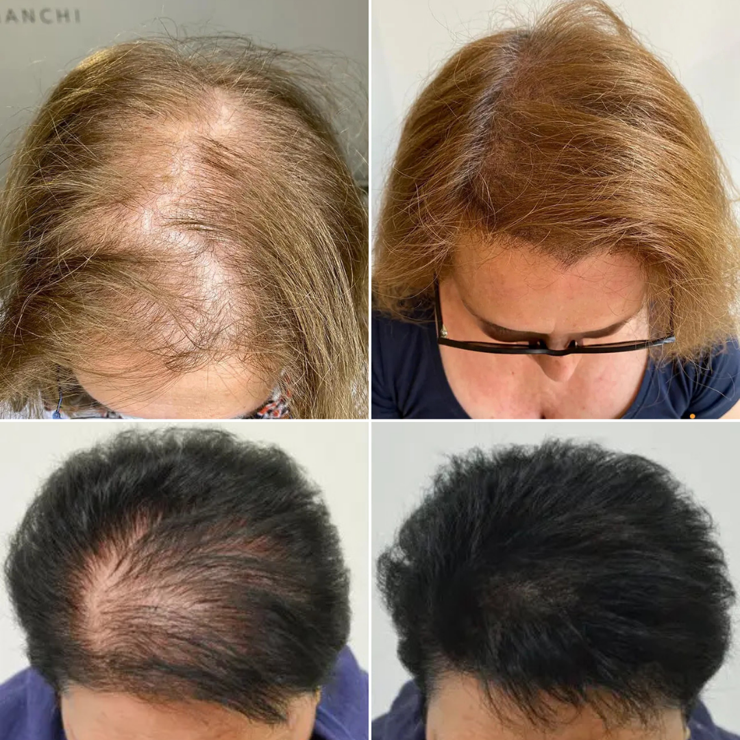 Tricopigmentare Îndesire
