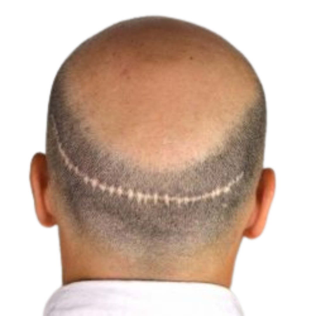 Acoperire cicatrice transplant FUT