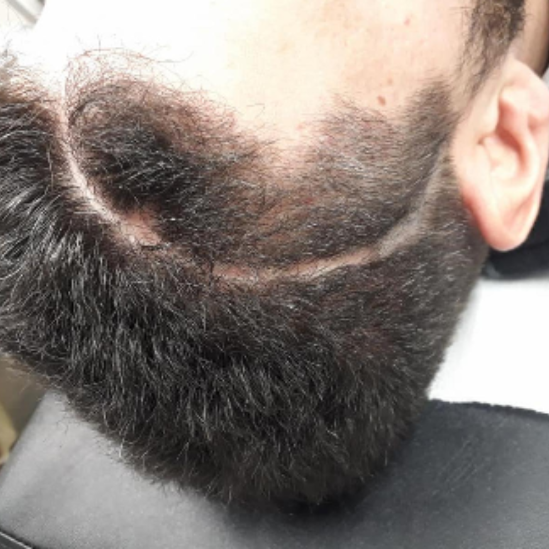 Rezultat acoperire cicatrici